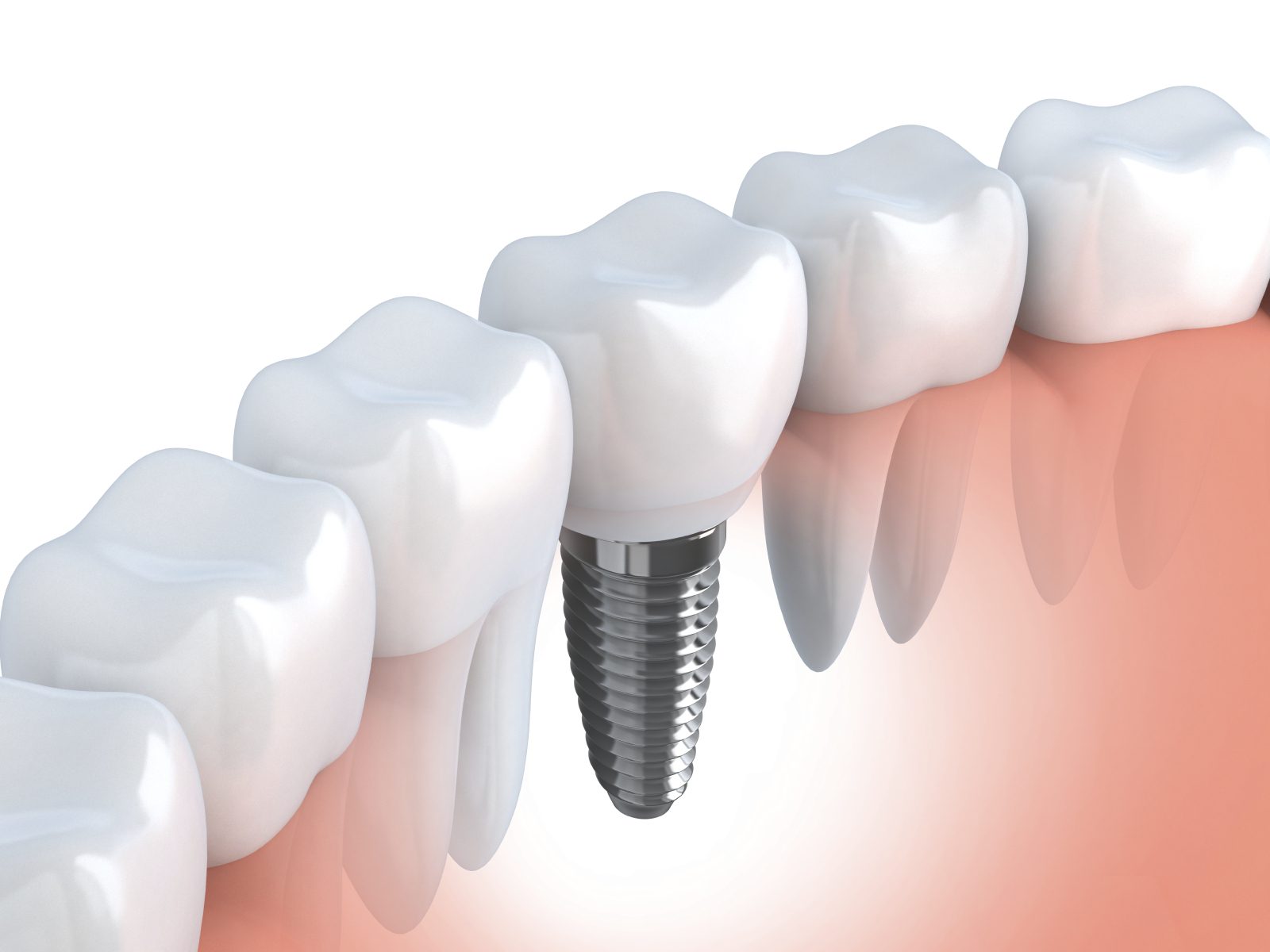 Melbourne dental implant