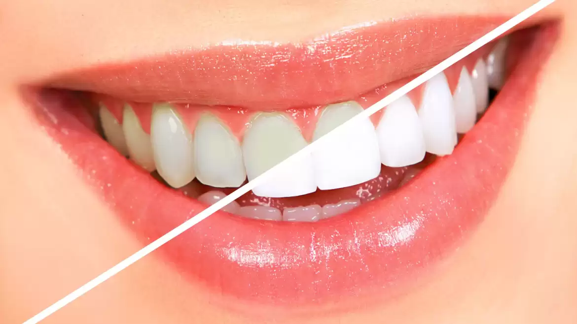 Easy Tips to Whiten Your Teeth Naturally