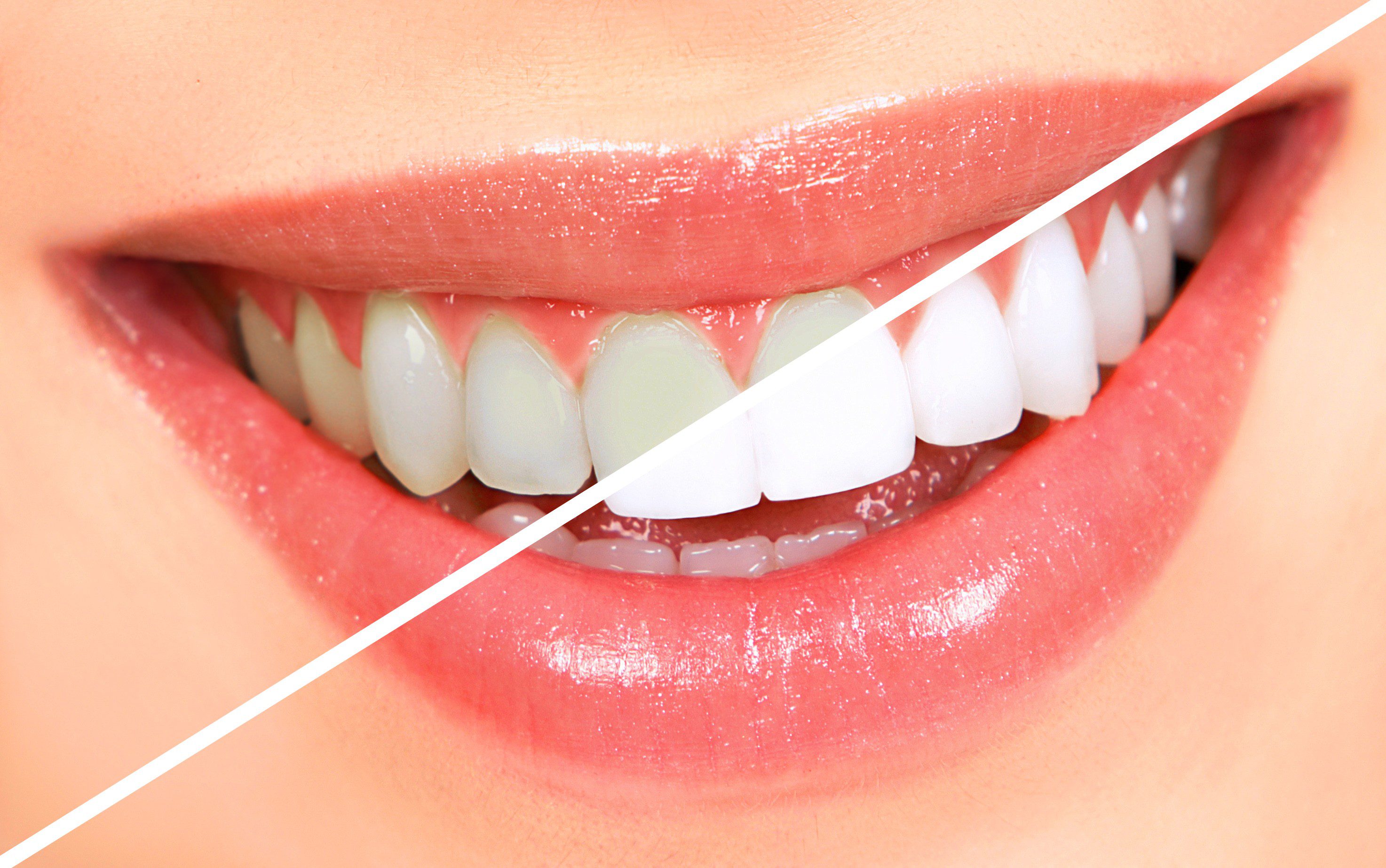 Teeth-Whitening