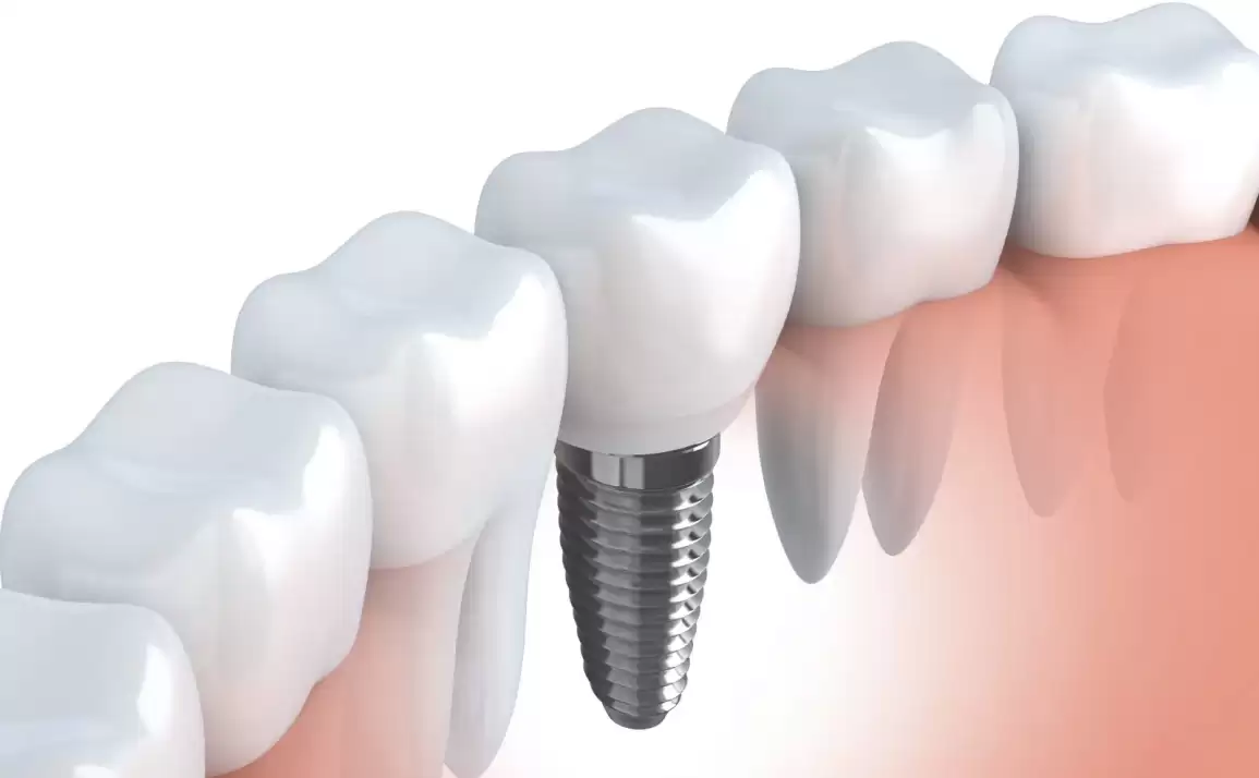 Pros and Cons of Dental Implants