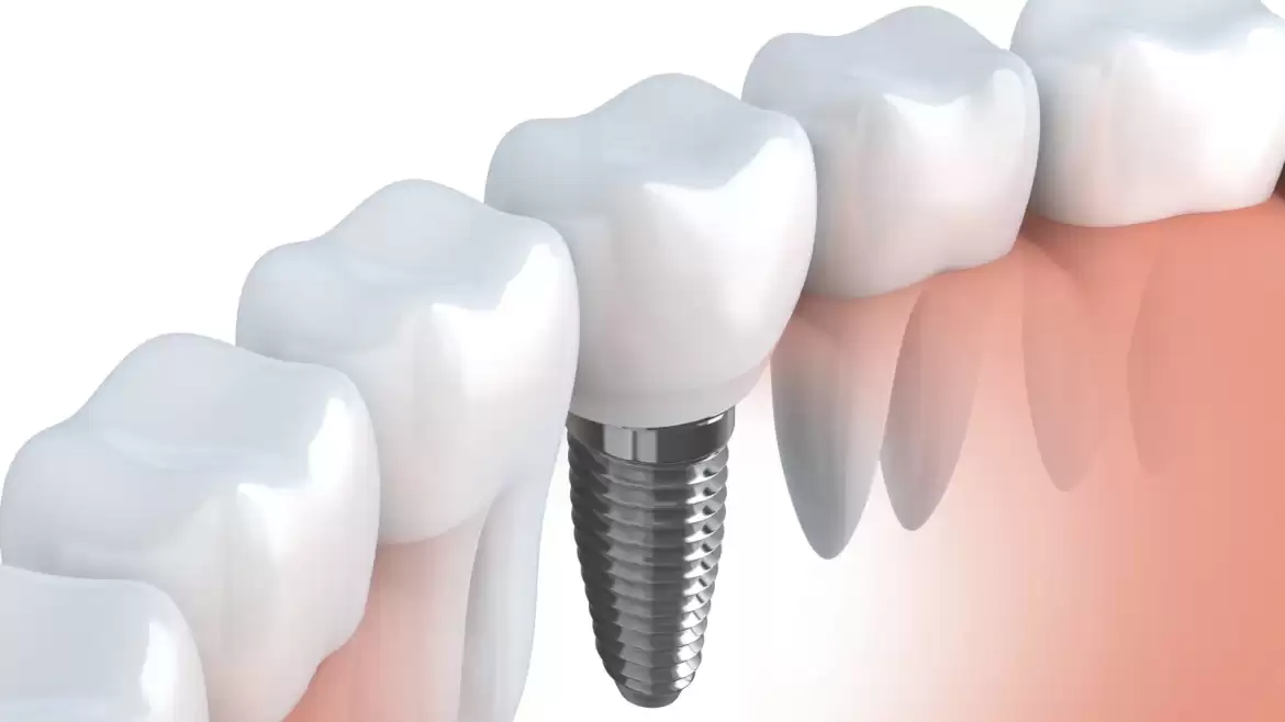 Pros and Cons of Dental Implants