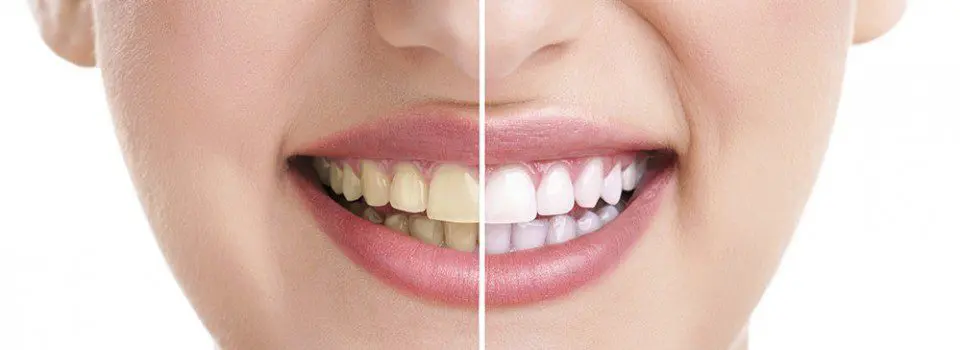 Simple Ways To Get A Striking Smile