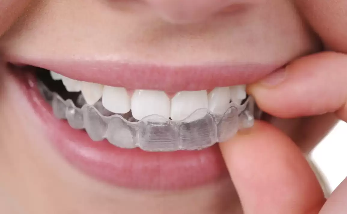 Top 7 Reasons To Jump On The Invisalign Bandwagon