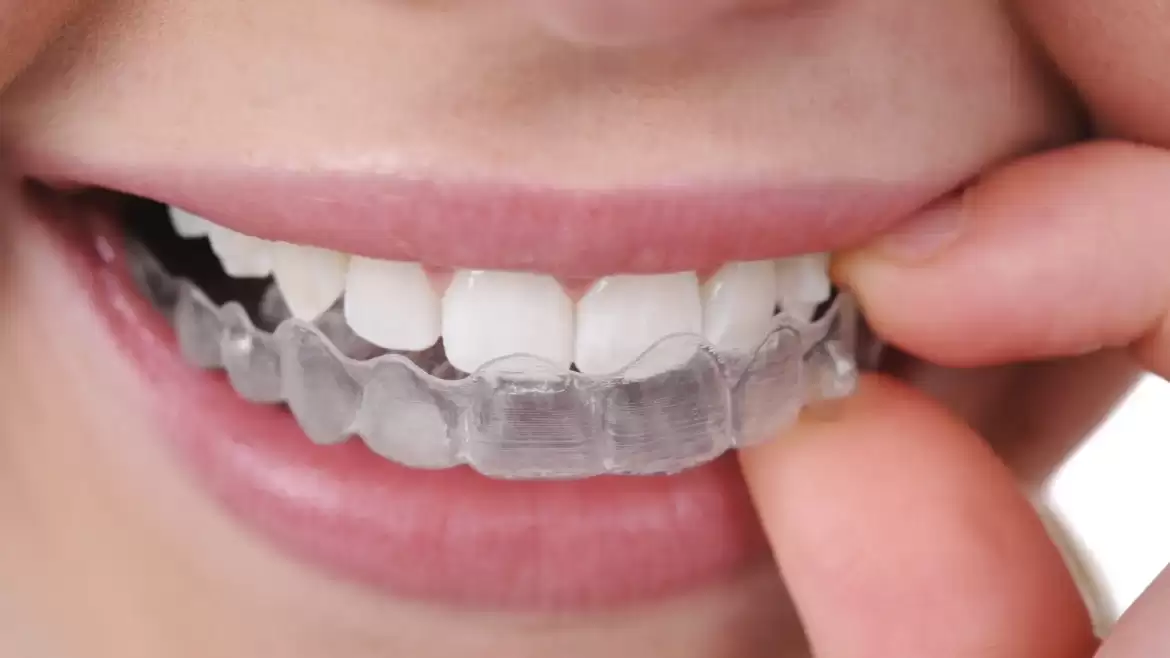 Top 7 Reasons To Jump On The Invisalign Bandwagon