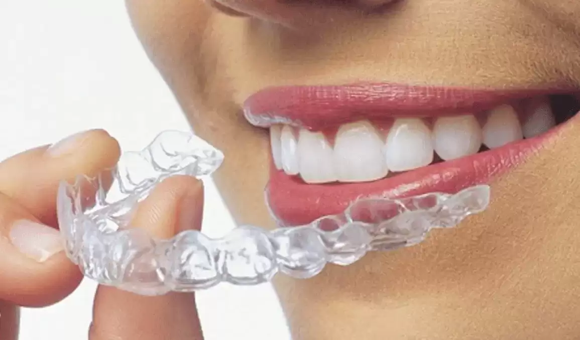 Invisible Braces – Common Questions and Answers