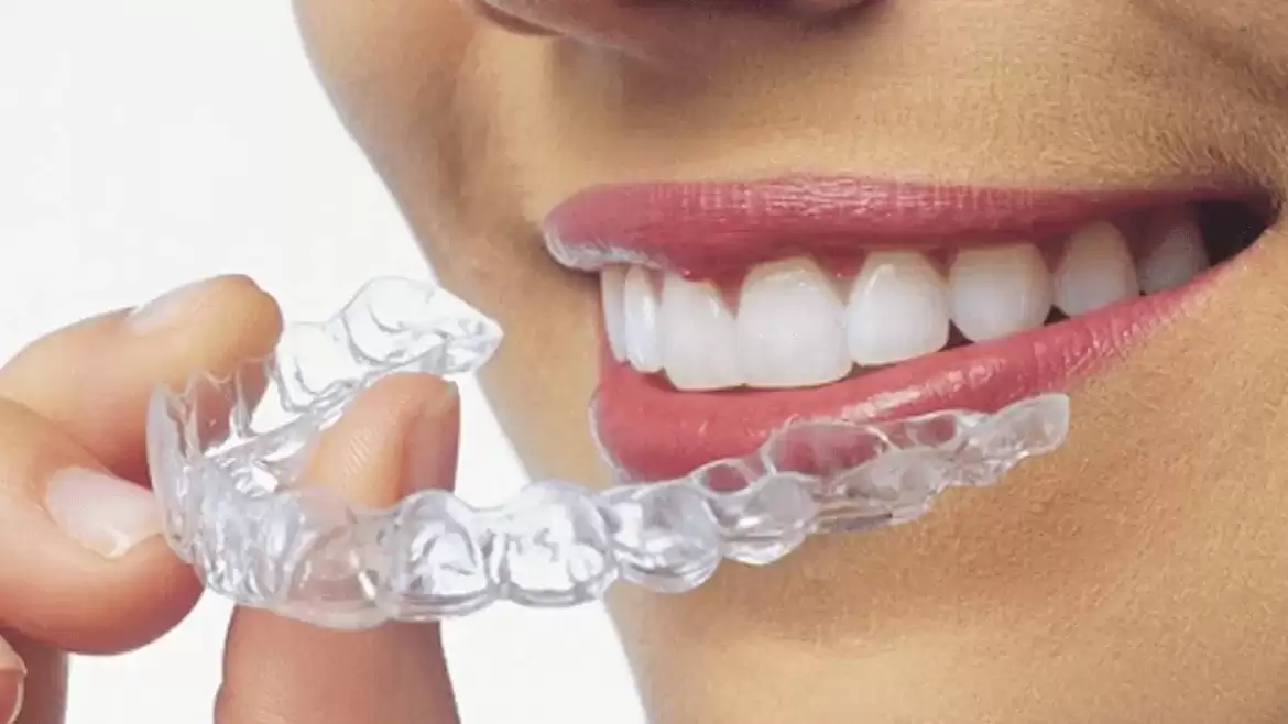 Invisible Braces – Common Questions and Answers