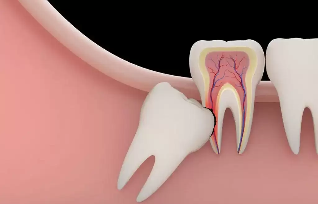 Wisdom Teeth Removal: Tips for Speedy Recovery