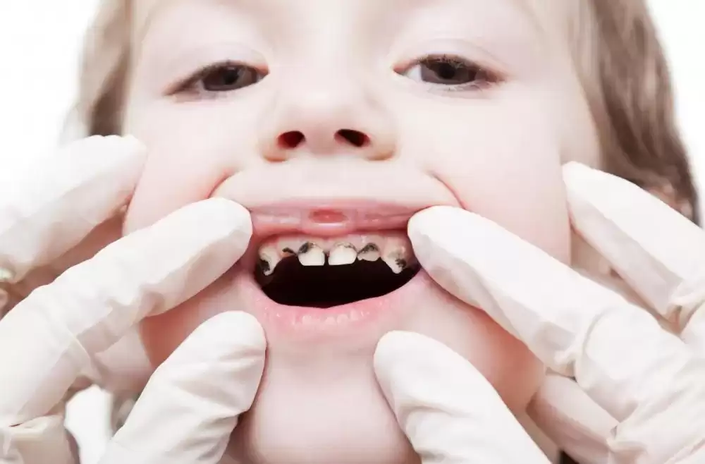 Parental Advice: How to Prevent Tooth Decay in Kids