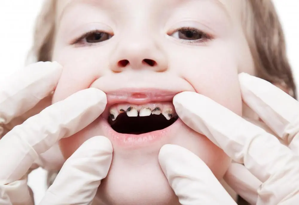 Parental Advice: How to Prevent Tooth Decay in Kids