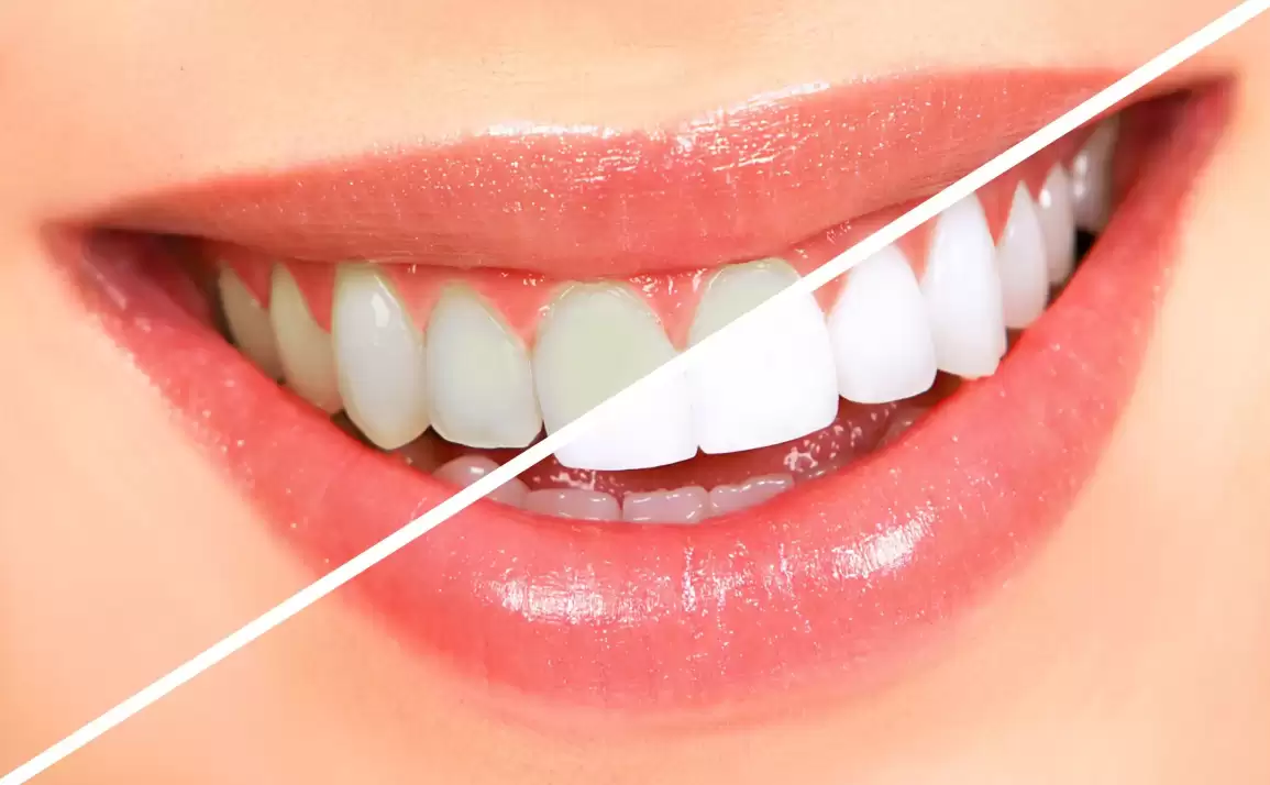 Is the Cost of Professional Teeth Whitening Worth It?