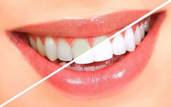 Cost of Professional Teeth Whitening