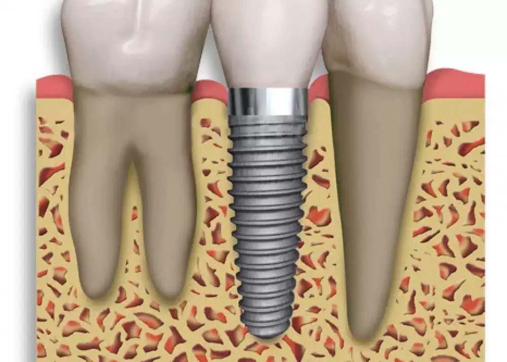 Suffering Tooth Decay As A Result Of Dry Mouth? Dental Implant Is Your Best Option!