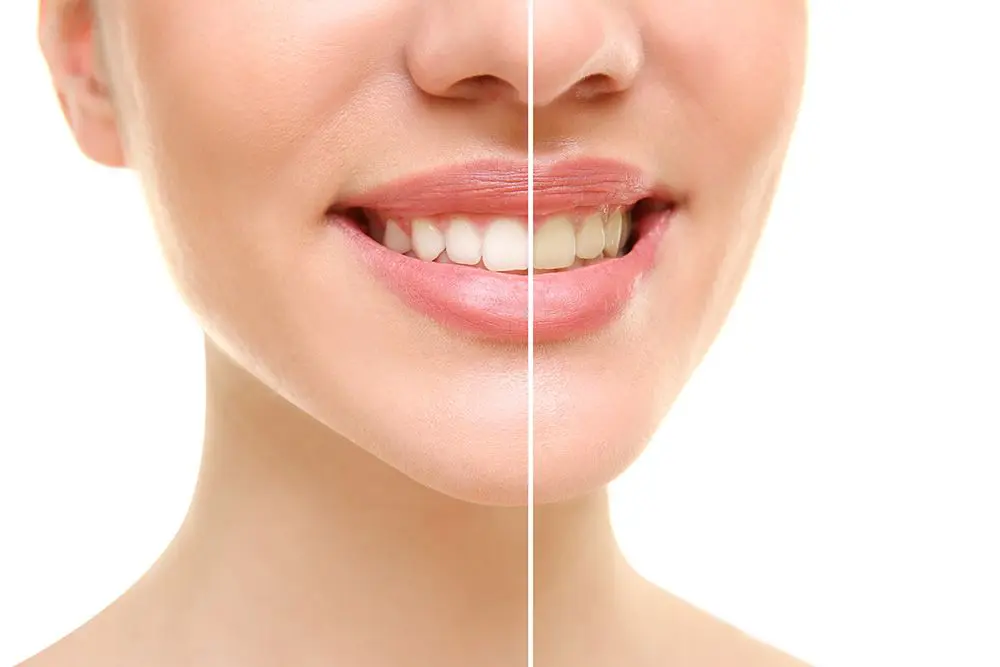 Complete Guide on Teeth Whitening in Melbourne