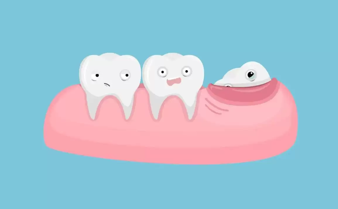 Get your Impacted Wisdom Teeth out – care for your Oral Health