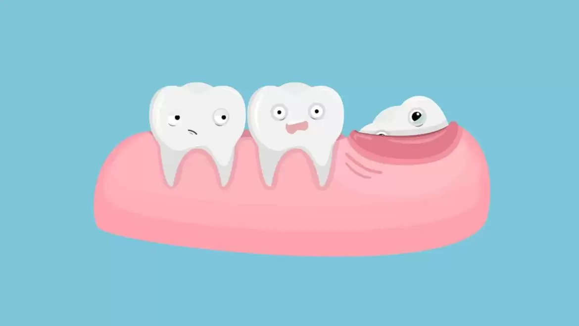 Get your Impacted Wisdom Teeth out – care for your Oral Health