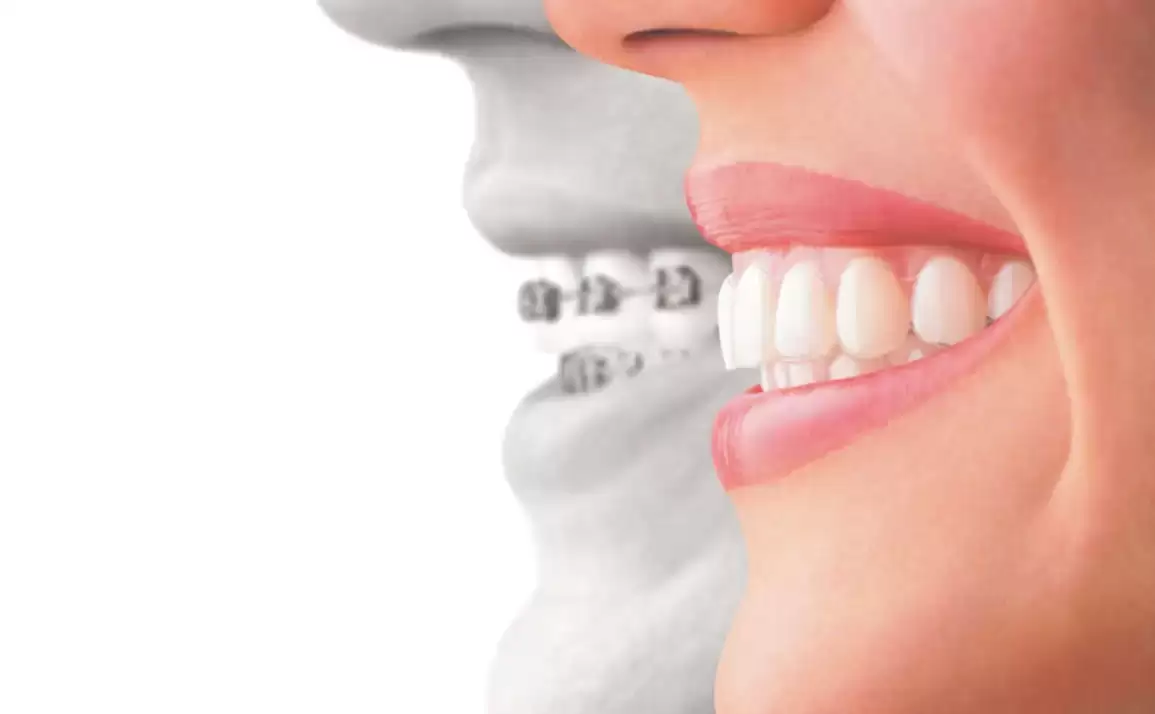 Reasons to Choose Invisible Braces Over Metal Braces