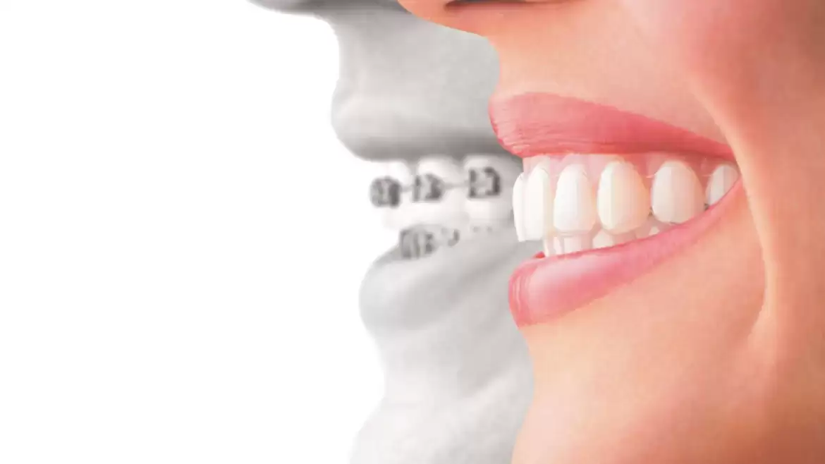 Reasons to Choose Invisible Braces Over Metal Braces