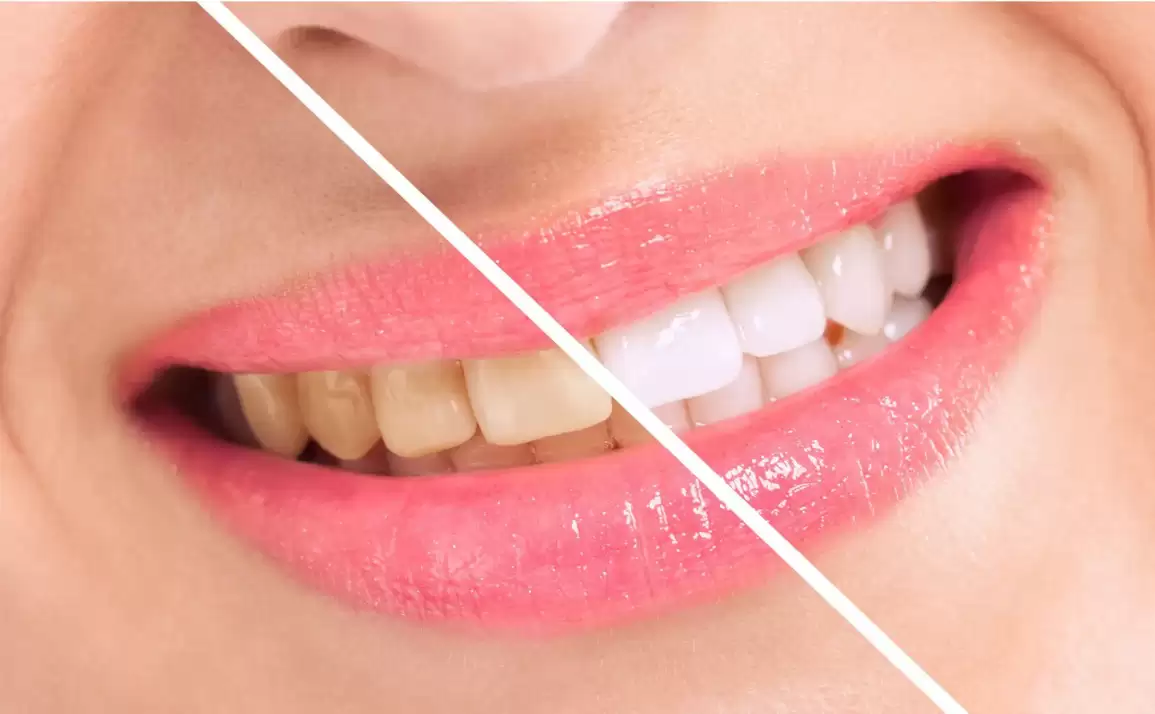 Teeth whitening to Enjoy Sparkling Pearly Whites!