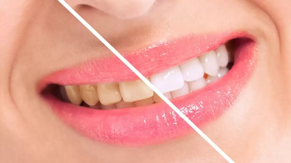 Teeth whitening to Enjoy Sparkling Pearly Whites!