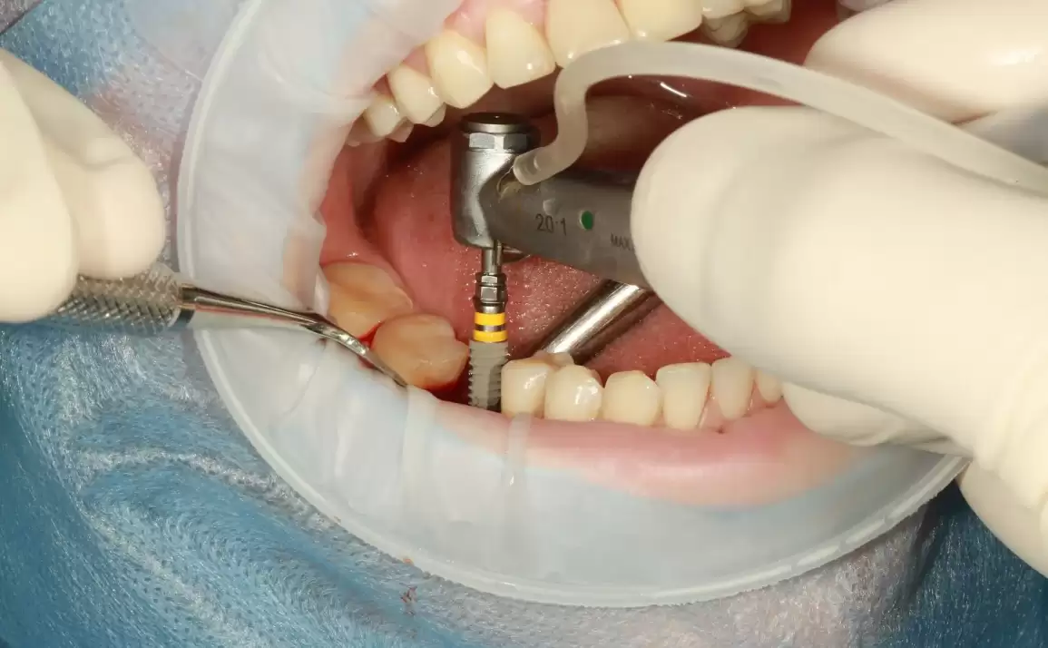 Quick Guide: Pre-Procedures Taken Before a Dental Implant