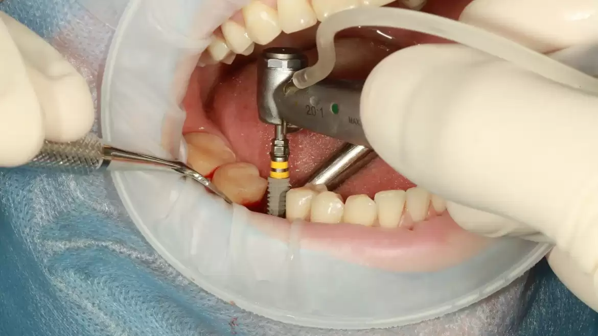 Quick Guide: Pre-Procedures Taken Before a Dental Implant