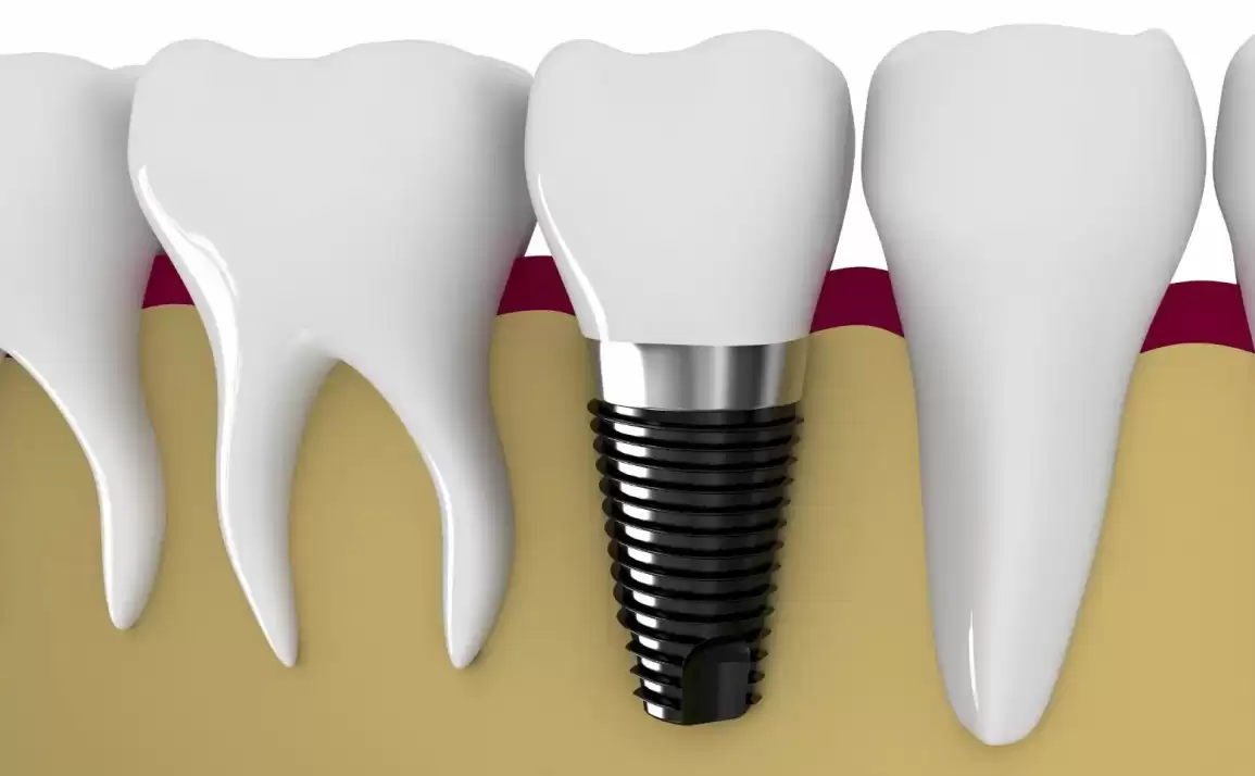 Evolution and the Changing Trends in Implant Dentistry