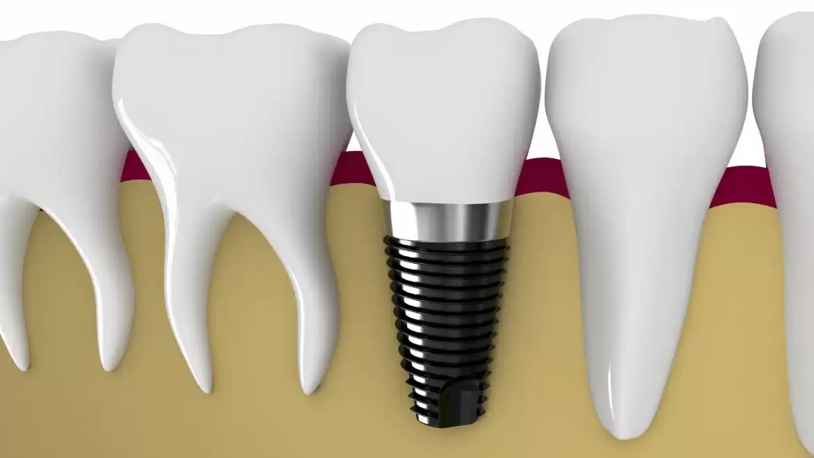 Evolution and the Changing Trends in Implant Dentistry