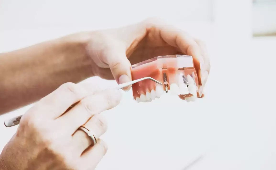 Can I Have Dental Implants And What Is The Success Rate?