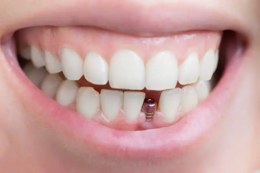 What Is The Best Option For Replacing Missing Teeth?