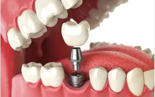 Are Dental Implants Permanent?