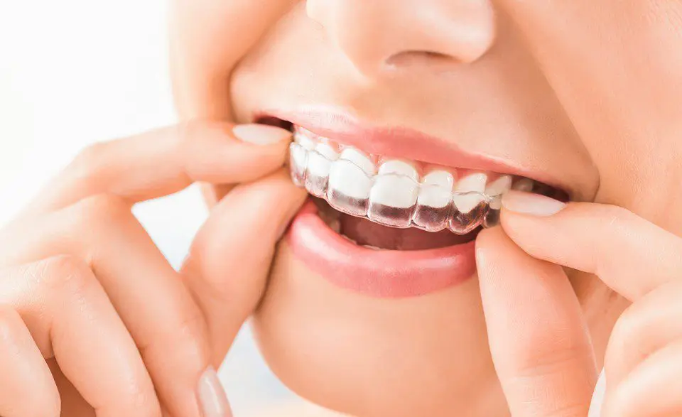 Are Invisible Braces Better Than Traditional Braces?