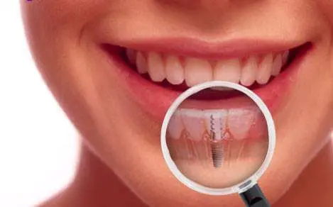 How Dental Implants Fare Better than Other Tooth Replacement Solutions