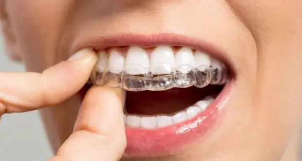 Invisible braces for a revitalised smile!