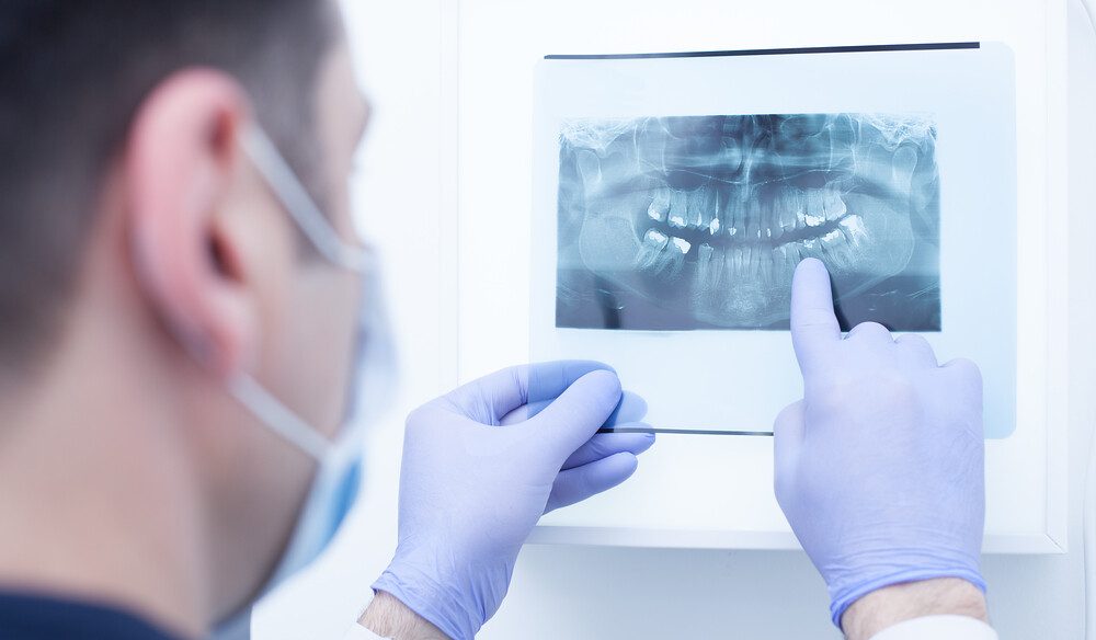 Everything you must know about Impacted Wisdom Teeth!
