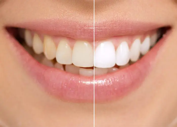 Advantages of Professional Teeth Whitening!