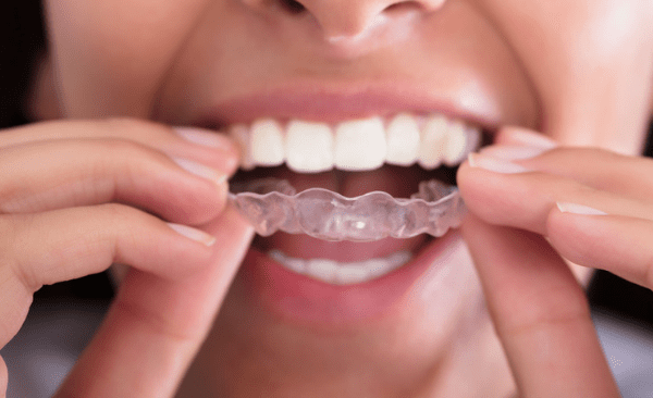 Are Invisible Braces right for me?
