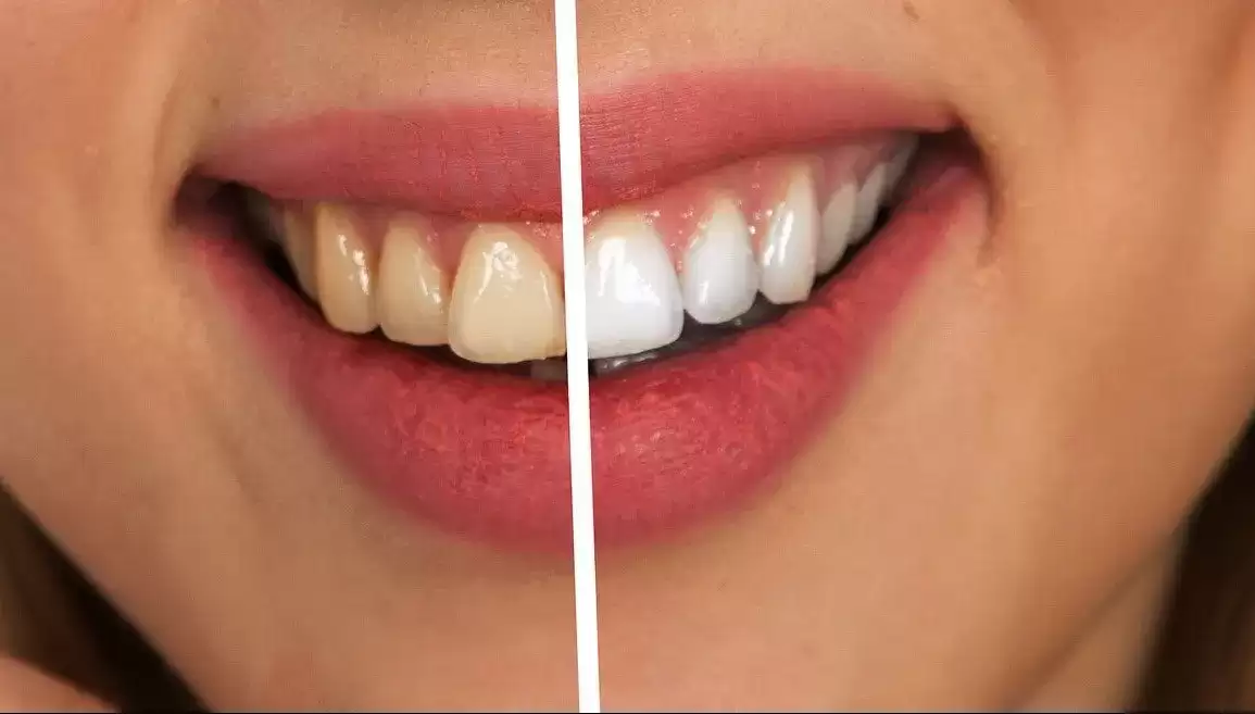 What Foods Stain Your Teeth The Most?