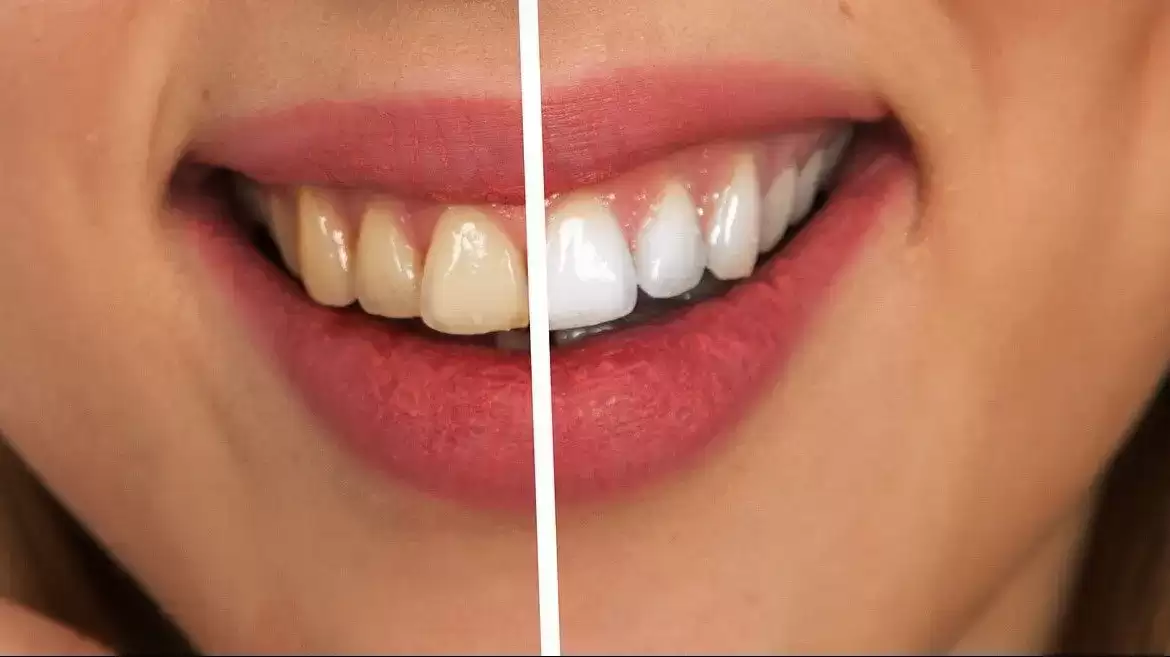 What Foods Stain Your Teeth The Most?