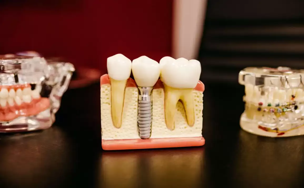 Signs You Need Dental Implants