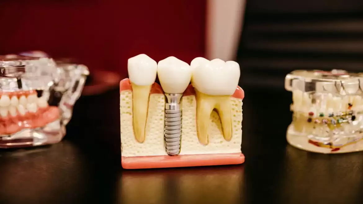 Signs You Need Dental Implants