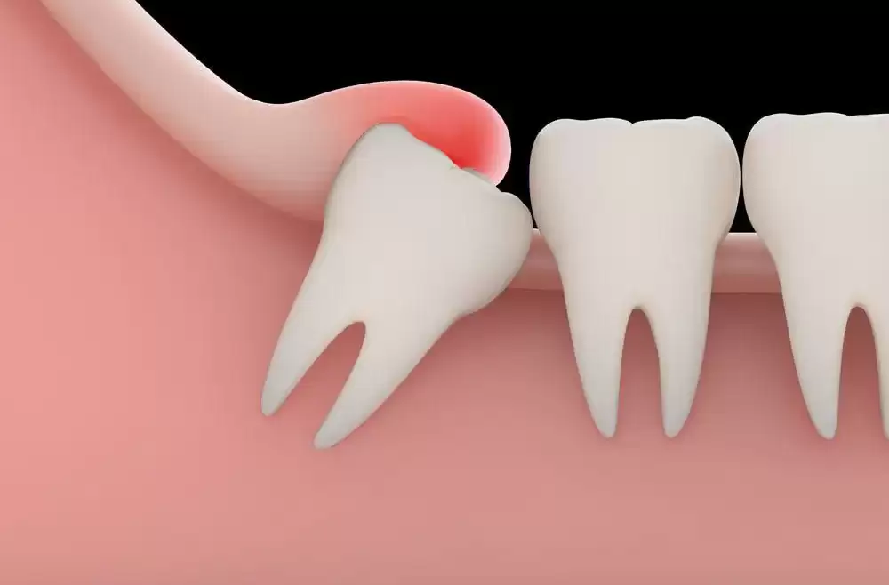 Signs You Should Remove Your Wisdom Teeth