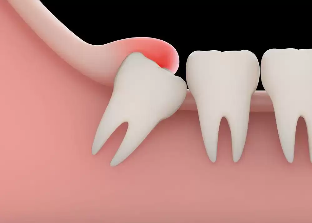 Signs You Should Remove Your Wisdom Teeth