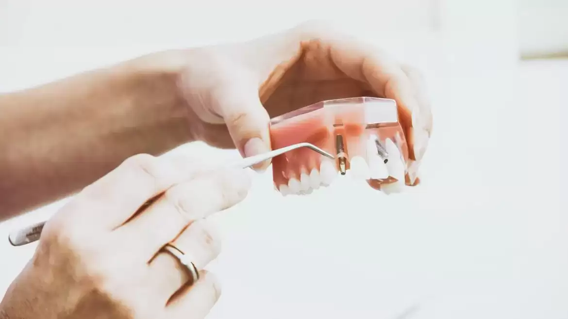 Dental Implants Melbourne – Why they’re Worth Considering