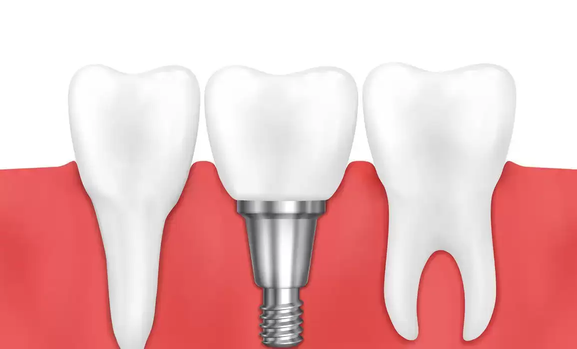 4 Reasons You Need Bone Grafting Before Placing Dental Implants