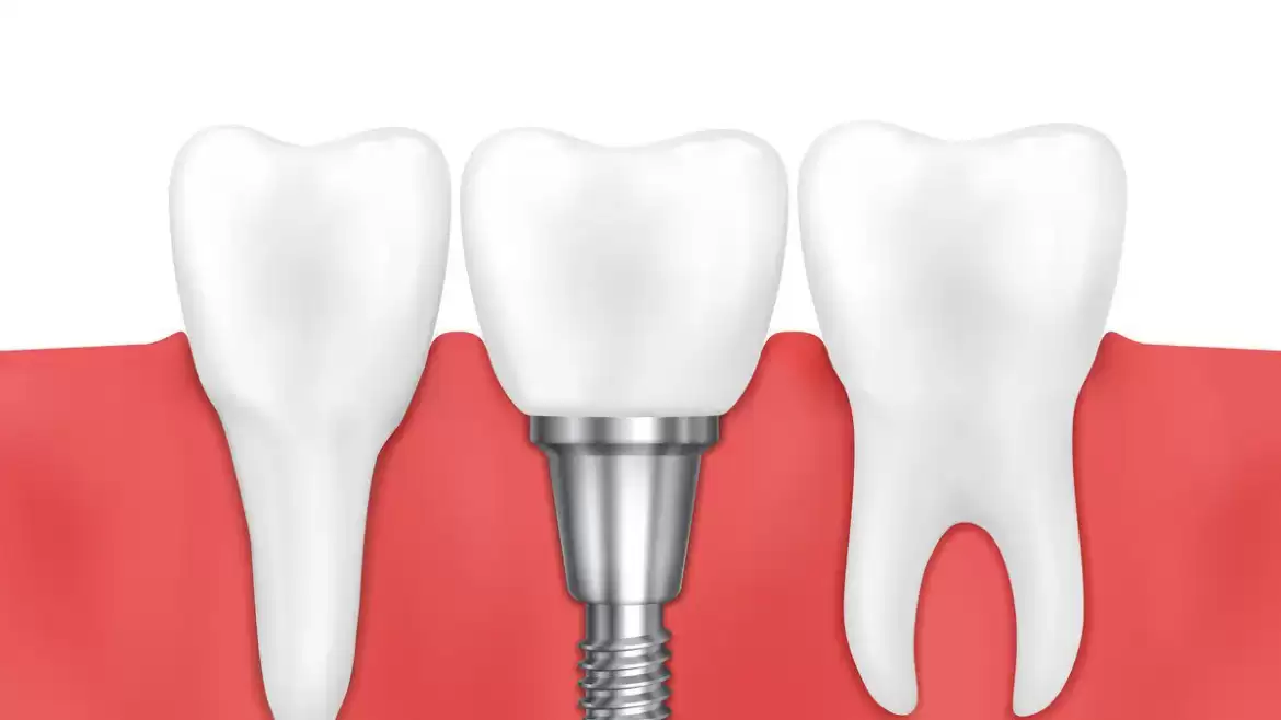 4 Reasons You Need Bone Grafting Before Placing Dental Implants