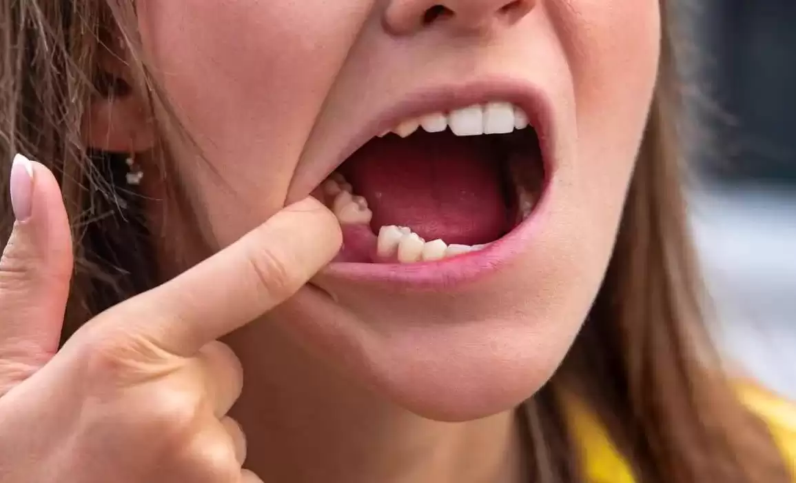 5 Ways That Missing a Tooth Can Affect Your Quality Of Life