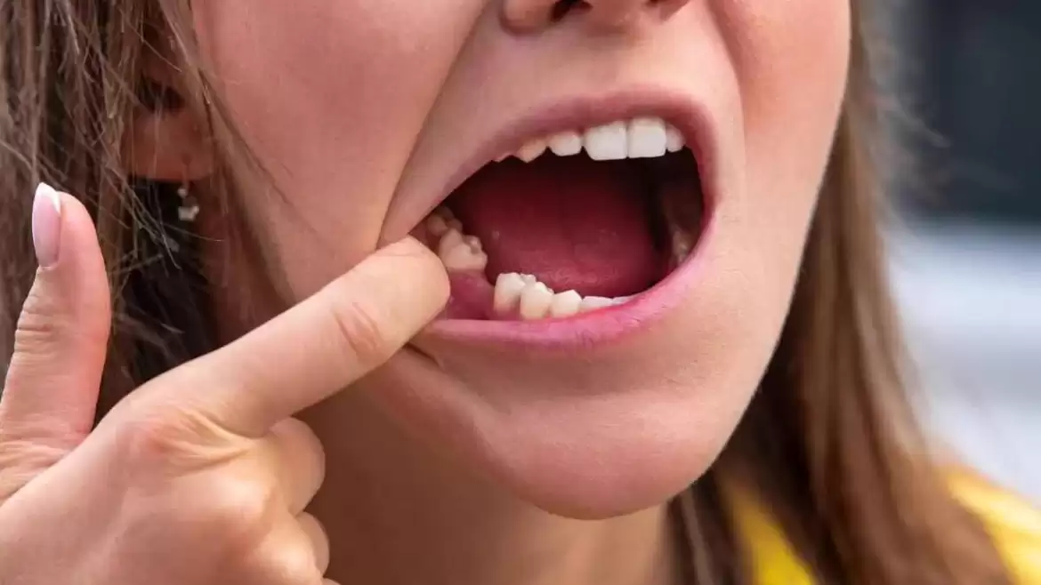 5 Ways That Missing a Tooth Can Affect Your Quality Of Life