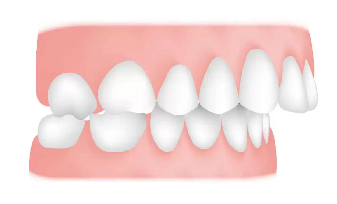 Reasons Why Treating Misaligned Teeth Is Important