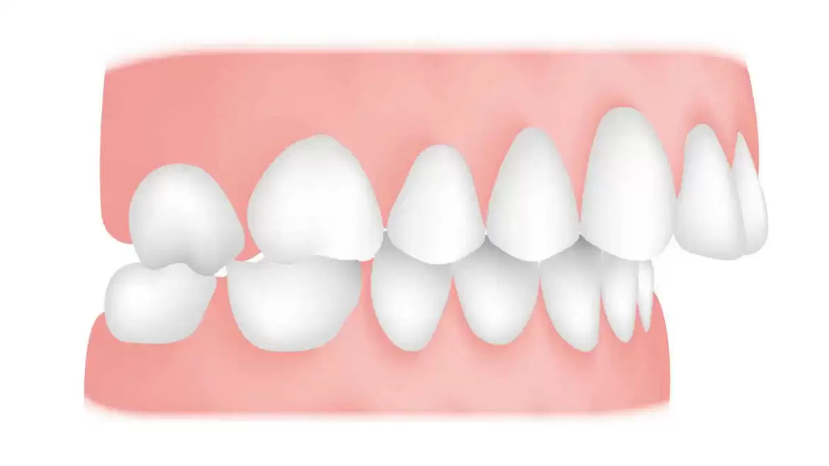 Reasons Why Treating Misaligned Teeth Is Important