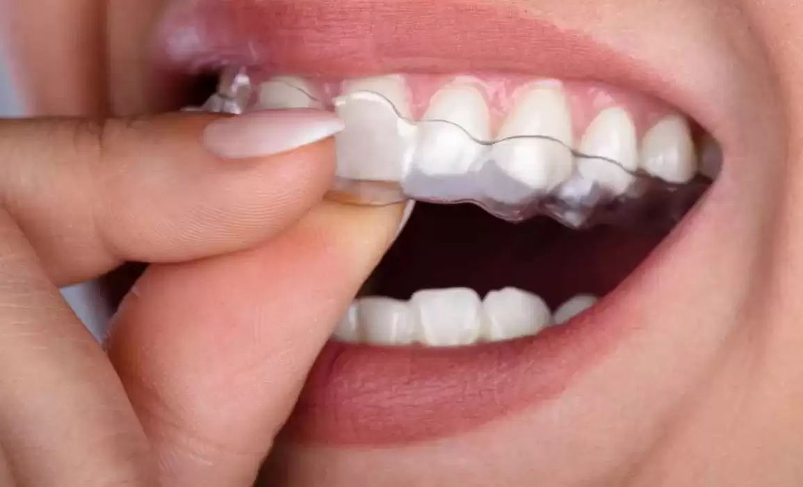 Should I Treat My Misaligned Teeth?